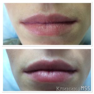 Увеличение губ в Киеве