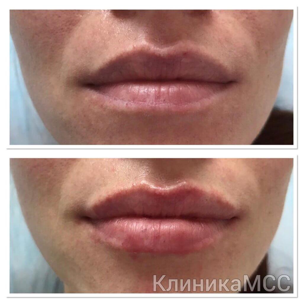 Увеличение губ в клинике Киев