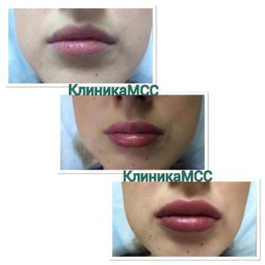 Увеличение объема губ киев