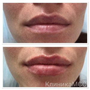 Увеличение губ в клинике Киев