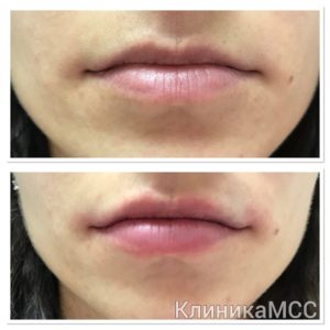 Увеличение губ фото до и после
