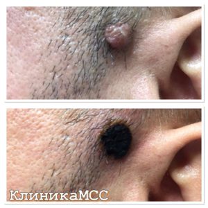 Удаление новообразований в Киеве