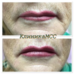 Рефреш губ до и после