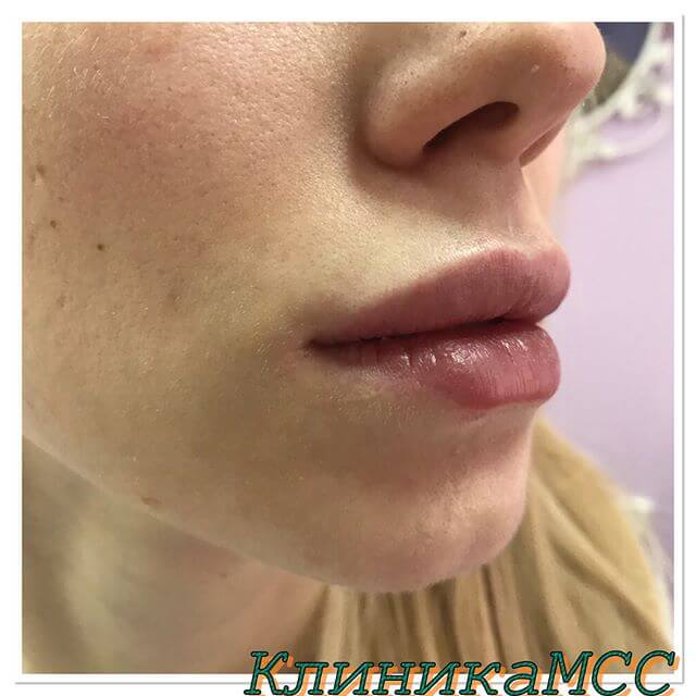 Увеличение губ Новогодние Скидки