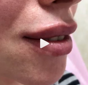 Повторная процедура увеличения губ