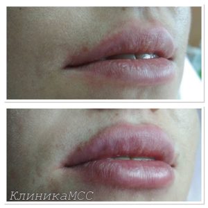 Сделать губы в Киеве