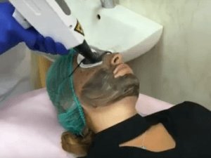 Лазерный пилинг