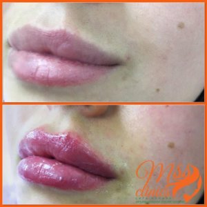 Увеличение губ с помощью уколов в Киеве