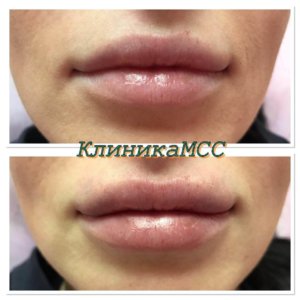 Губы сделать в Киеве