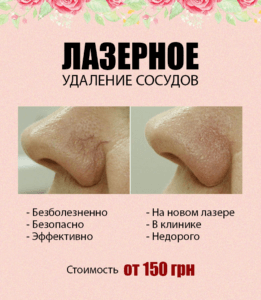Лазерное удаление сосудов на позняках